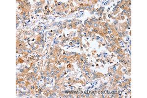 Immunohistochemistry of Human liver cancer using PPOX Polyclonal Antibody at dilution of 1:40 (PPOX 抗体)