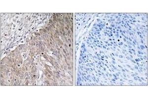 Immunohistochemistry analysis of paraffin-embedded human cervix carcinoma tissue, using APOL2 Antibody. (Apolipoprotein L 2 抗体  (AA 191-240))