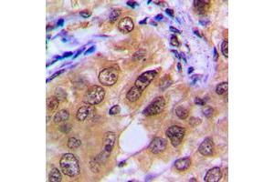 Immunohistochemical analysis of PTTG1/2/3 staining in human breast cancer formalin fixed paraffin embedded tissue section. (PTTG1/2/3 抗体  (Center))