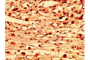 IHC image of ABIN7158070 diluted at 1:300 and staining in paraffin-embedded human melanoma performed on a Leica BondTM system. (LRRFIP2 抗体  (AA 211-342))