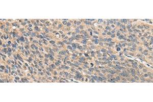 Immunohistochemistry of paraffin-embedded Human cervical cancer tissue using RPS14 Polyclonal Antibody at dilution of 1:50(x200) (RPS14 抗体)