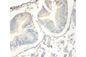 Immunohistochemistry of paraffin-embedded human endometrial cancer using ABIN7144333 at dilution of 1:100 (SLPI 抗体  (AA 26-132))