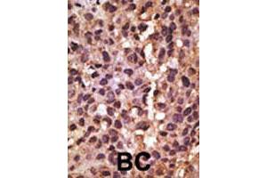 Formalin-fixed and paraffin-embedded human breast cancer tissue reacted with BNIP3 polyclonal antibody  , which was peroxidase-conjugated to the secondary antibody, followed by DAB staining. (BNIP3 抗体  (AA 215-252))