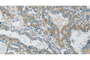 Immunohistochemistry of paraffin-embedded Human thyroid cancer tissue using Connexin-45 Polyclonal Antibody at dilution 1:50 (GJC1 抗体)