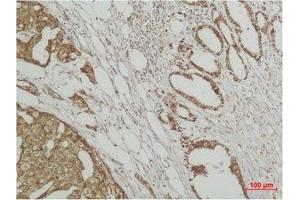 Immunohistochemical analysis of paraffin-embedded human Breast caricnoma using ERK 3 Polyclonal Antibody. (MAPK6 抗体)