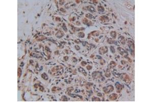 Detection of CRN in Human Breast Cancer Tissue using Polyclonal Antibody to Corin (CRN) (Corin 抗体  (AA 134-573))