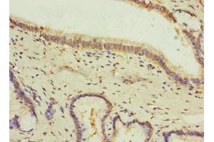 Immunohistochemistry of paraffin-embedded human prostate cancer using ABIN7153669 at dilution of 1:100 (GIPR 抗体  (AA 22-138))