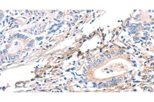 Immunohistochemistry of paraffin-embedded Human gastric cancer using TWF2 Polyclonal Antibody at dilution of 1:40 (TWF2 抗体)