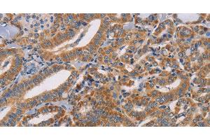 Immunohistochemistry of paraffin-embedded Human thyroid cancer tissue using CDK11A/B Polyclonal Antibody at dilution 1:50 (Cdk11A/B 抗体)