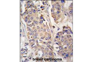 Formalin-fixed and paraffin-embedded human breast carcinoma tissue reacted with ACO2 antibody , which was peroxidase-conjugated to the secondary antibody, followed by DAB staining.