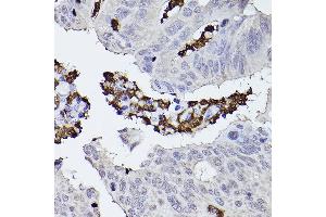 Immunohistochemistry of paraffin-embedded human colon carcinoma using CFP Rabbit pAb (ABIN6127651, ABIN6138467, ABIN6138468 and ABIN6221045) at dilution of 1:50 (40x lens).