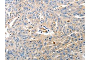 The image on the left is immunohistochemistry of paraffin-embedded Human ovarian cancer tissue using ABIN7190149(CD93 Antibody) at dilution 1/60, on the right is treated with synthetic peptide. (CD93 抗体)