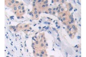 Detection of CAP1 in Human Breast cancer Tissue using Polyclonal Antibody to Channel Activating Protease 1 (CAP1) (PRSS8 抗体  (AA 33-218))
