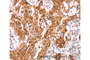 Immunohistochemistry of Human lung cancer using NCEH1 Polyclonal Antibody at dilution of 1:80 (NCEH1 抗体)