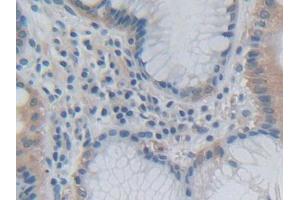 DAB staining on IHC-P; Samples: Human Stomach cancer Tissue (Growth Hormone 2 抗体  (AA 27-217))