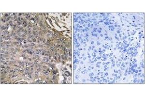 Immunohistochemistry analysis of paraffin-embedded human lung carcinoma, using SH2D1B Antibody. (SH2D1B 抗体  (AA 71-120))