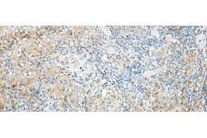 Immunohistochemistry of paraffin-embedded Human cervical cancer tissue using RPP14 Polyclonal Antibody at dilution of 1:60(x200) (RPP14 抗体)
