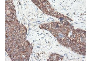 Immunohistochemical staining of paraffin-embedded Adenocarcinoma of Human breast tissue using anti-PFKP mouse monoclonal antibody. (PFKP 抗体)