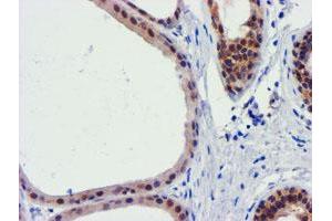 Immunohistochemical staining of paraffin-embedded Human breast tissue using anti-FBXO21 mouse monoclonal antibody. (FBXO21 抗体)