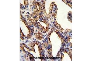 Formalin-fixed and paraffin-embedded human prostate carcinoma with TROP2 Antibody (Center), which was peroxidase-conjugated to the secondary antibody, followed by DAB staining. (TACSTD2 抗体  (AA 162-190))