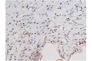 Immunohistochemistry (IHC) image for anti-Signal Transducer and Activator of Transcription 3 (Acute-Phase Response Factor) (STAT3) (pTyr705) antibody (ABIN6255995)