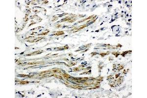 IHC-P: Caveolin-2 antibody testing of human lung cancer tissue (Caveolin 2 抗体  (AA 1-17))