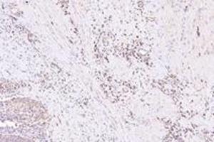 Immunohistochemistry analysis of paraffin-embedded human bladder cancer using NXF2 (ABIN7074901) at dilution of 1: 3000 (NXF2 抗体)