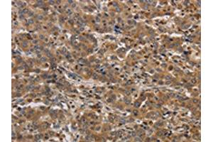 The image on the left is immunohistochemistry of paraffin-embedded Human liver cancer tissue using ABIN7192097(RAB22A Antibody) at dilution 1/20, on the right is treated with synthetic peptide. (RAB22A 抗体)