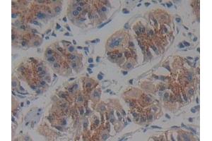 Detection of IFNa/bR2 in Human Stomach cancer Tissue using Polyclonal Antibody to Interferon Alpha/Beta Receptor 2 (IFNa/bR2)