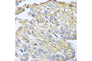 Immunohistochemistry of paraffin-embedded human prostate cancer using CCL8 antibody (ABIN5975074) at dilution of 1/100 (40x lens). (CCL8 抗体)