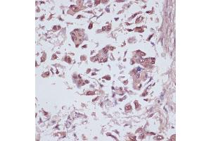 Immunohistochemistry of paraffin-embedded human lung cancer using U2 antibody (ABIN6134442, ABIN6149752, ABIN6149755 and ABIN6217061) at dilution of 1:100 (40x lens). (U2AF1 抗体  (AA 1-100))