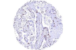 Mature placenta lacking PARP1 staining in the syncytiotrophoblast