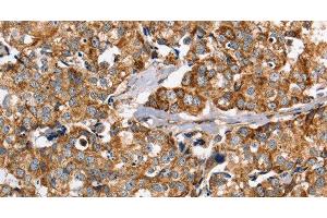 Immunohistochemistry of paraffin-embedded Human breast cancer using PPOX Polyclonal Antibody at dilution of 1:40 (PPOX 抗体)