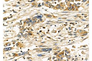 ABIN6262457 and ABIN6278271 at 1/100 staining Human gastric cancer by IHC-P. (IFITM3 抗体  (N-Term))