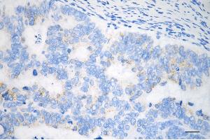 Immunohistochemistry was performed on paraffin-embedded human sigmoid colon carcinoma using TNF receptor associated protein 1 antibody (ABIN7800567), 1:200). (Recombinant TRAP1 抗体)