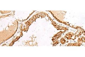 Immunohistochemistry of paraffin-embedded Human thyroid cancer tissue using LGALSL Polyclonal Antibody at dilution of 1:70(x200)
