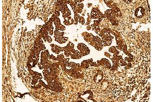 ABIN6262955 and ABIN6272923 at 1/100 staining Human pancreatic cancer by IHC-P.