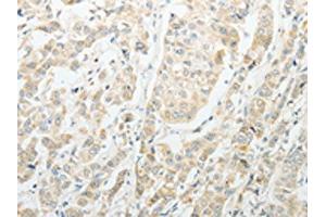 The image on the left is immunohistochemistry of paraffin-embedded Human breast cancer tissue using ABIN7189714(AGBL1 Antibody) at dilution 1/15, on the right is treated with synthetic peptide. (AGBL1 抗体)