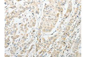 The image on the left is immunohistochemistry of paraffin-embedded Human breast cancer tissue using ABIN7189714(AGBL1 Antibody) at dilution 1/15, on the right is treated with synthetic peptide. (AGBL1 抗体)