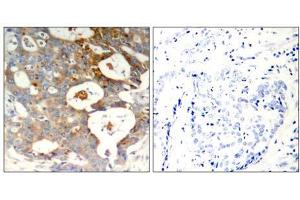 Immunohistochemical analysis of paraffin-embedded human breast carcinoma tissue using IkB-ε (Phospho-Ser22) antibody (E011213). (NFKBIE 抗体  (pSer22))