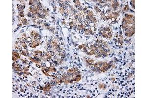 Immunohistochemical staining of paraffin-embedded Carcinoma of prostate tissue using anti-LIPG mouse monoclonal antibody. (LIPG 抗体)