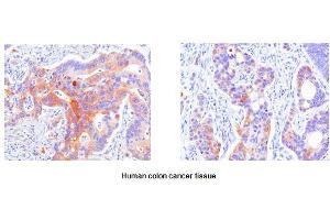 Paraffin embedded sections of human colon cancer tissue were incubated with anti-human Hsp27 (1:50) for 2 hours at room temperature. (HSP27 抗体)