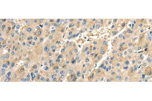 Immunohistochemistry of paraffin-embedded Human liver cancer tissue using COX2 Polyclonal Antibody at dilution 1:40 (COX2 抗体)