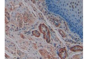 DAB staining on IHC-P; Samples: Human Esophagus cancer Tissue (SNCG 抗体  (AA 1-121))