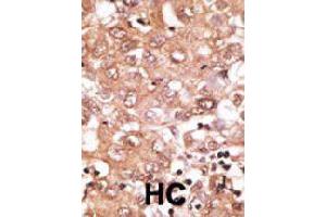 Formalin-fixed and paraffin-embedded human hepatocellular carcinoma tissue reacted with GDF2 polyclonal antibody  , which was peroxidase-conjugated to the secondary antibody, followed by DAB staining. (GDF2 抗体  (N-Term))