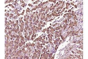 Paraformaldehyde-fixed, paraffin embedded Human liver cancer Antigen retrieval by boiling in sodium citrate buffer (pH6. (Myoglobin 抗体  (AA 2-154))