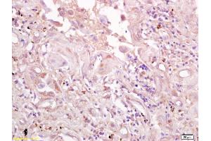 Formalin-fixed and paraffin embedded human lung carcinoma labeled with Anti-CD71/TFR/Transferrin Polyclonal Antibody, Unconjugated (ABIN1386360) at 1:200 followed by conjugation to the secondary antibody and DAB staining. (Transferrin Receptor 抗体  (AA 621-720))
