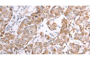 Immunohistochemistry of paraffin-embedded Human breast cancer using ATPIF1 Polyclonal Antibody at dilution of 1:50 (ATPase Inhibitory Factor 1 抗体)