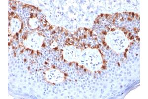 Formalin-fixed, paraffin-embedded human Melanoma stained with MART-1 Mouse Recombinant Monoclonal Antibody (rMLANA/788). (Recombinant MLANA 抗体)