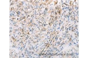 Immunohistochemistry of Human gastic cancer using NPPC Polyclonal Antibody at dilution of 1:70 (NPPC 抗体)